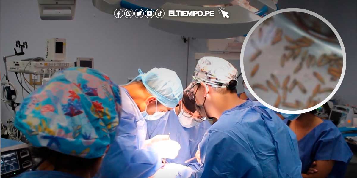 Extraen más de 100 gusanos de la boca de una mujer de 40 años en Lima