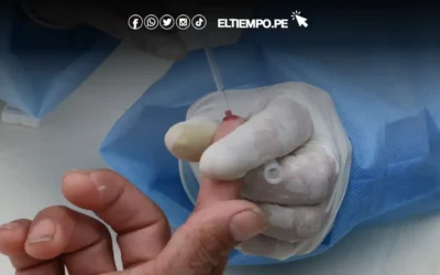 Piura: Investigan dos posibles casos de viruela del mono tras el primer confirmado