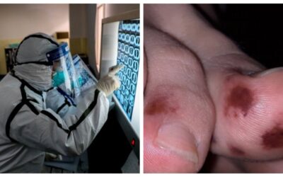 Moretones y ampollas en los pies serían nuevos síntomas del Covid-19, según estudio