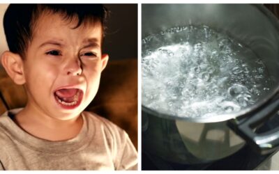 ¡Atención, padres! Aumentan casos de niños quemados durante la cuarentena