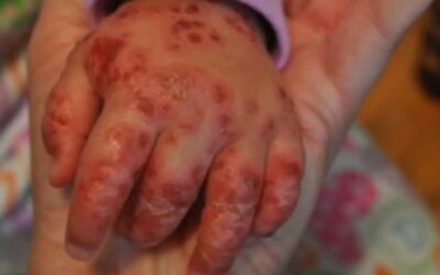 Coxsackie: Ante primer caso, escolares deben ir a cuarentena