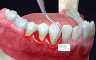 EsSalud: infecciones crónicas en las encías agravaría situación de pacientes con COVID-19