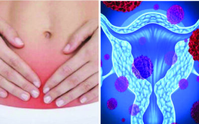 Cáncer de cuello uterino: Estos son los 5 malos hábitos que te lo pueden causar