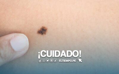 ¿Dónde hacer tratamiento de un melanoma benigno en Perú?
