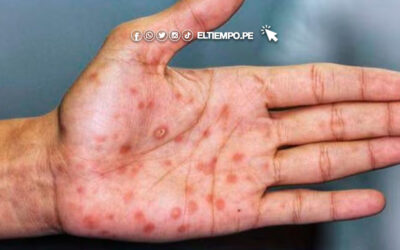 Alerta en Perú: Viruela del mono se propaga en Lima y genera preocupación nacional