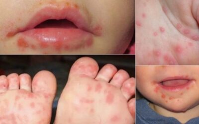 Virus Coxsackie: todo lo que se sabe sobre la enfermedad de manos, pies y boca