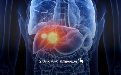 ¿Qué es el cáncer de hígado, síntomas y qué tratamientos existen para enfrentar al carcinoma hepatocelular?