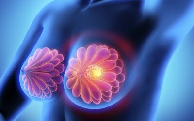 Cáncer de mama supera al cáncer de pulmón como el más diagnosticado en el mundo, según estudio