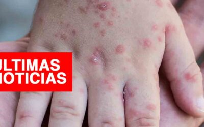 Coxsackie en Perú EN VIVO: últimas noticias sobre los casos del virus de manos, boca y pies en Piura