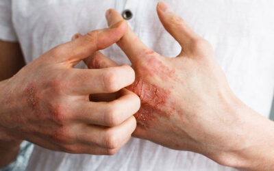 Sepa cómo cuidarse de la dermatitis atópica