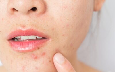 ¿Sufres desequilibrio hormonal? Evita consumir estos alimentos