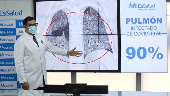 essalud-dano-pulmonar