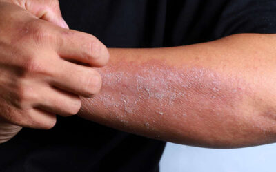 ¿Qué son los hongos y cómo evitarlos?