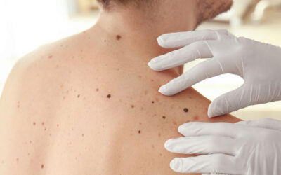Esos lunares podrían ser melanomas