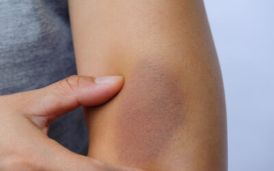 ¿Por qué te salen moretones en el cuerpo sin golpearte?