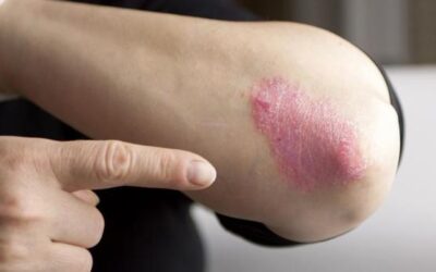 EsSalud: nuevos pacientes con psoriasis se duplicaron durante el último año