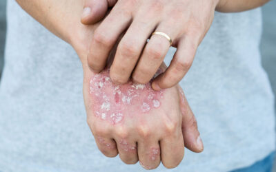 Psoriasis: lo que debo saber de esta enfermedad