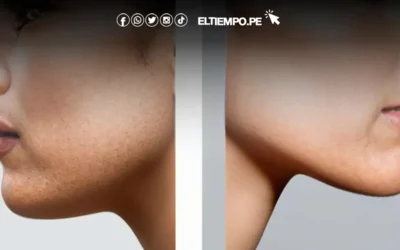 Cuánto cuesta una rinoplastia en Perú: Precios y factores a tener en cuenta