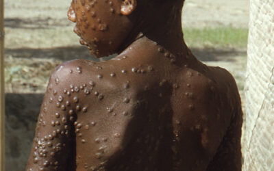 Viruela del mono: ¿Cuáles son los síntomas y cómo se contagia esta enfermedad?