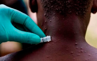 Viruela del mono: desarrollan tests para detectar la enfermedad