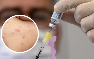 Vacunación viruela del mono: primer lote será destinado para población con tratamiento antirretroviral