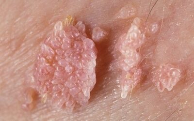 Virus del Papiloma Humano: Sigue estos consejos para evitar contraerlo