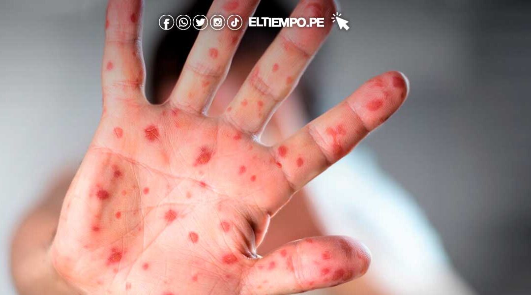 Viruela del mono: Minsa no ha elaborado un plan específico ante alerta epidemiológica por la nueva variante