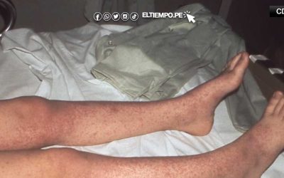 En Texas muere de sarampión un segundo niño no vacunado