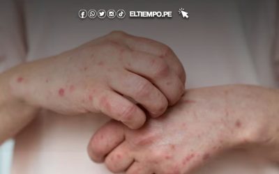 Minsa emitió alerta epidemiológica por riesgo de contagio de sarampión: ¿qué implica?