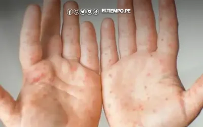 Alerta en Lambayeque: más de 30 casos de infección viral “mano, pie y boca”