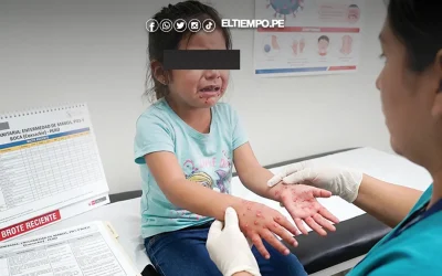 Virus Coxsackie se expande en colegios de Piura y Sullana