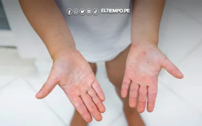 Labios secos y somnolencia: dos síntomas de alarma del virus Coxsackie