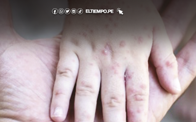 Dirección Sub Regional de Salud confirman 10 casos de virus coxsackie en Sullana y Bellavista