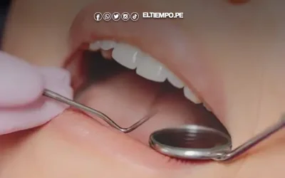 Carcinoma es el tipo de cáncer oral más frecuente en el Perú, según estudio